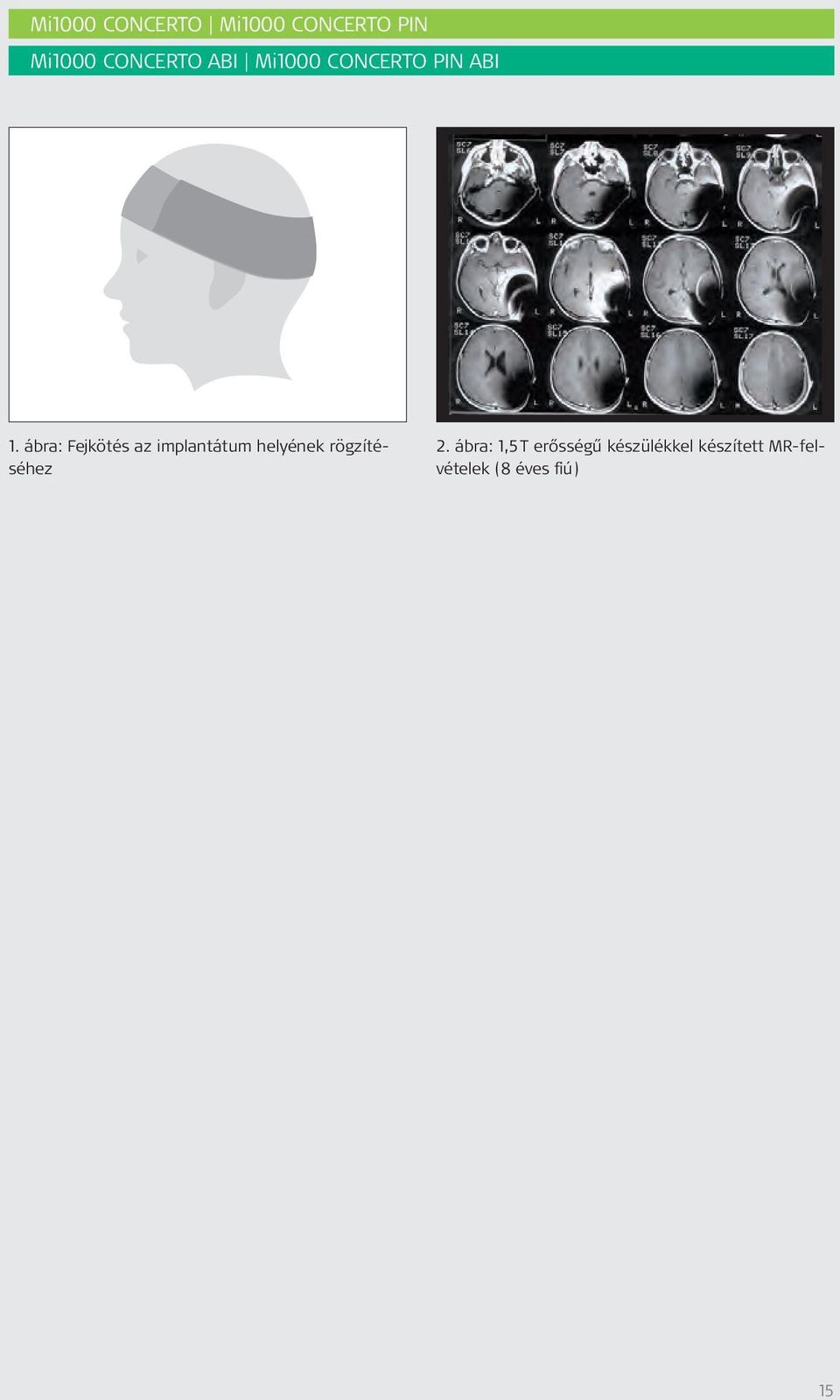 ábra: Fejkötés az implantátum helyének rögzítéséhez