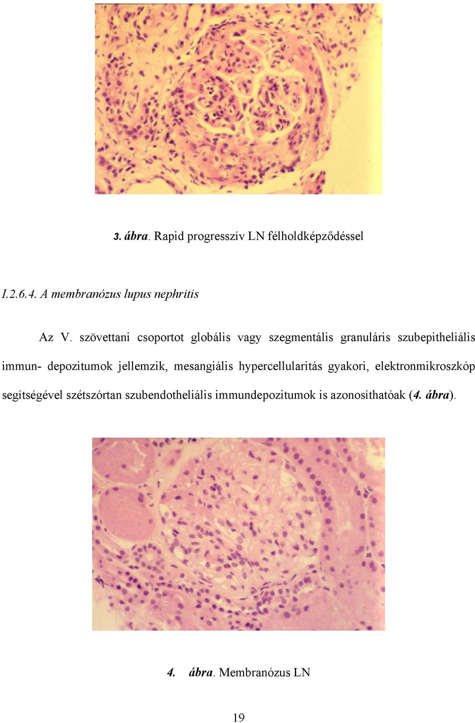 depozitumok jellemzik, mesangiális hypercellularitás gyakori, elektronmikroszkóp segítségével