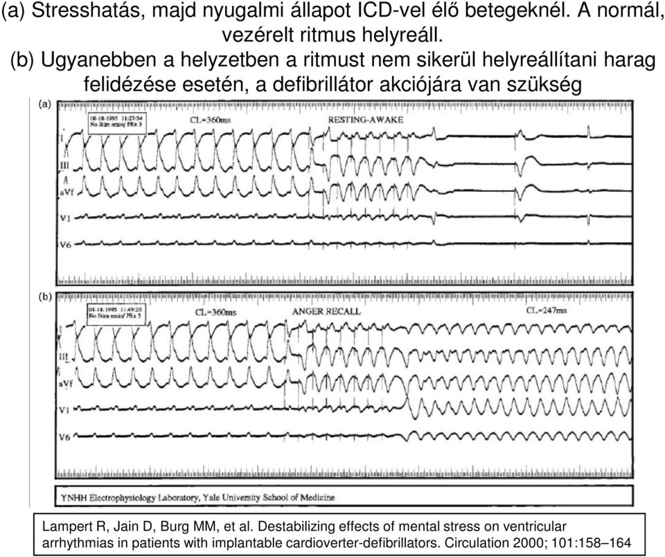 defibrillátor akciójára van szükség Lampert R, Jain D, Burg MM, et al.