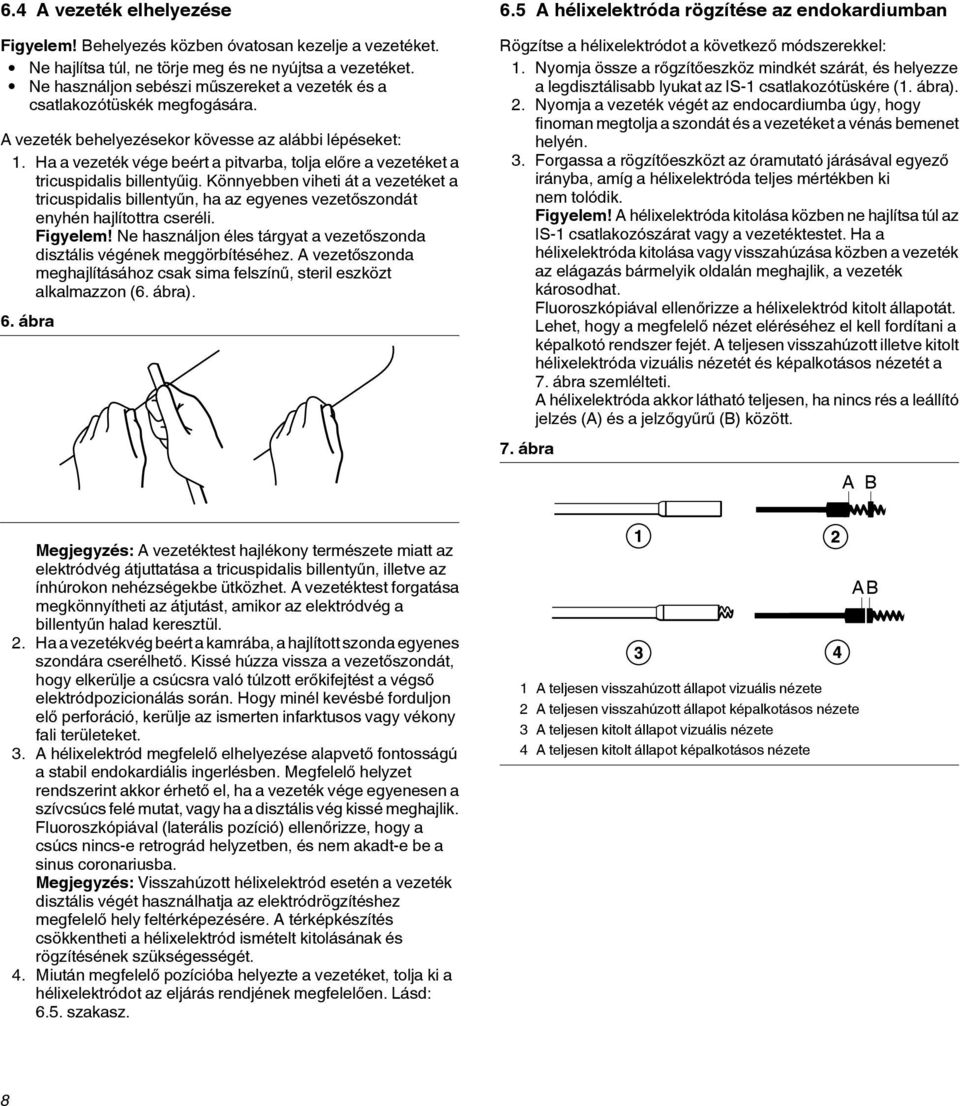 Ha a vezeték vége beért a pitvarba, tolja előre a vezetéket a tricuspidalis billentyűig.