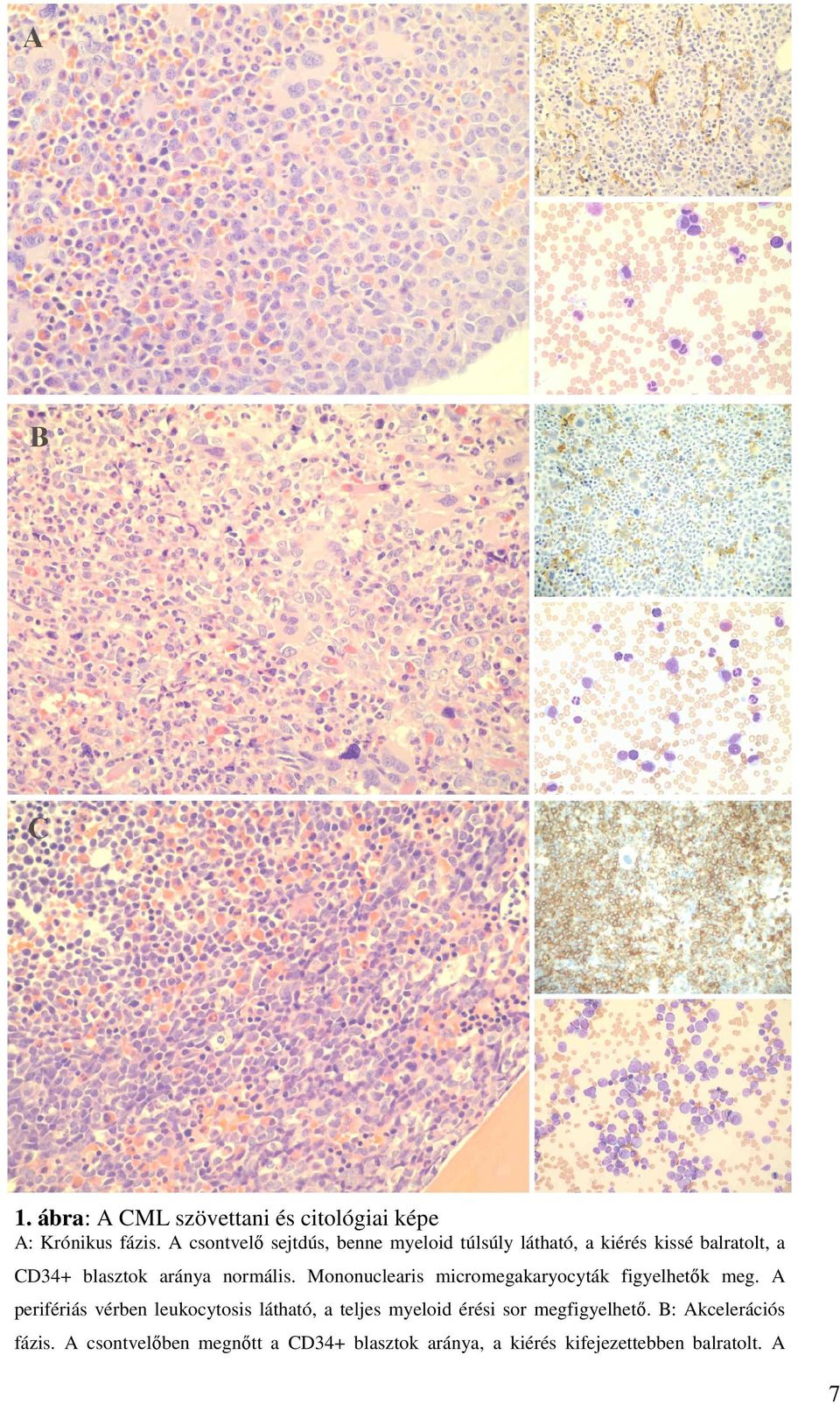 normális. Mononuclearis micromegakaryocyták figyelhetők meg.