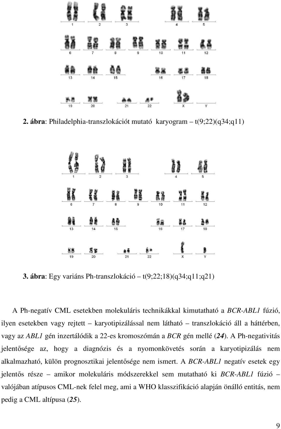 nem látható transzlokáció áll a háttérben, vagy az ABL1 gén inzertálódik a 22-es kromoszómán a BCR gén mellé (24).