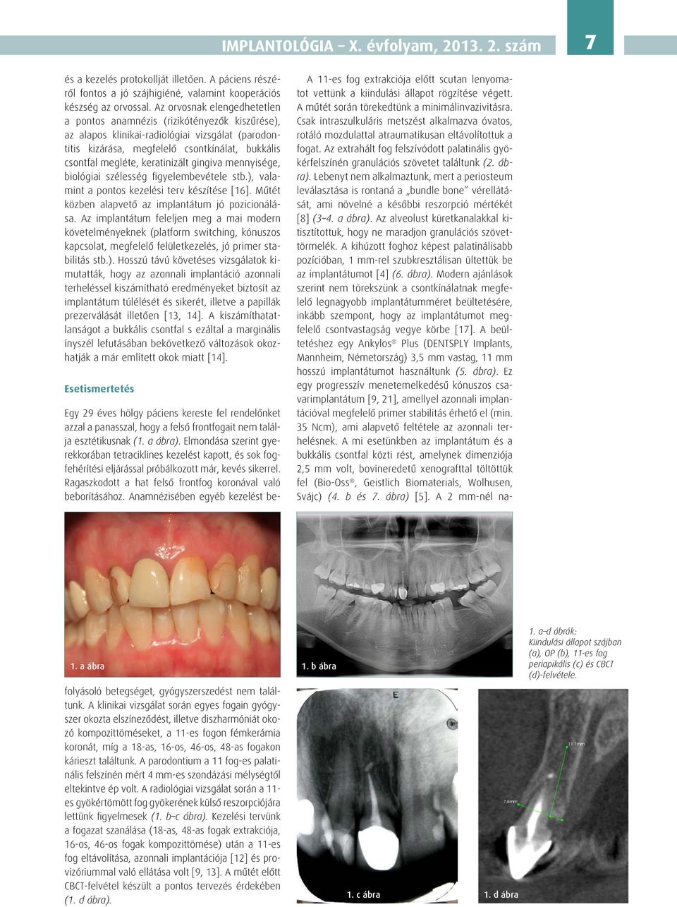 keratinizált gingiva mennyisége, biológiai szélesség figyelembevétele stb.), valamint a pontos kezelési terv készítése [16]. Műtét közben alapvető az implantátum jó pozicionálása.