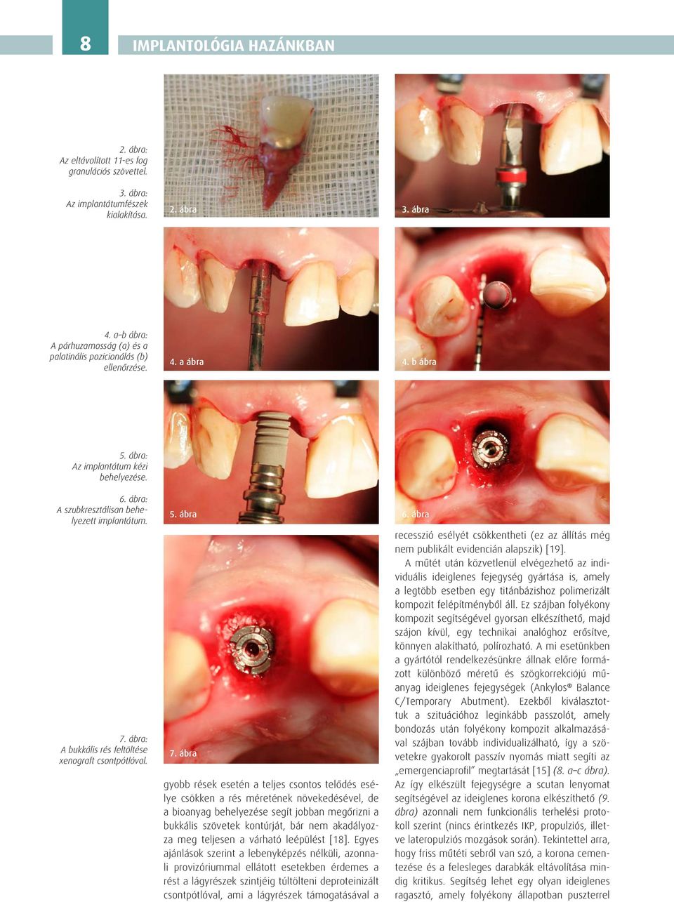 ábra: A bukkális rés feltöltése xenograft csontpótlóval. 5. ábra 7.