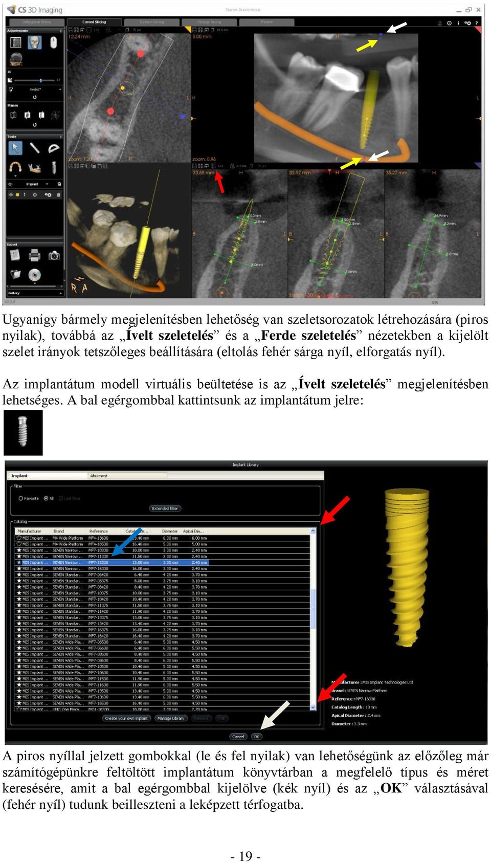 A bal egérgombbal kattintsunk az implantátum jelre: A piros nyíllal jelzett gombokkal (le és fel nyilak) van lehetőségünk az előzőleg már számítógépünkre feltöltött