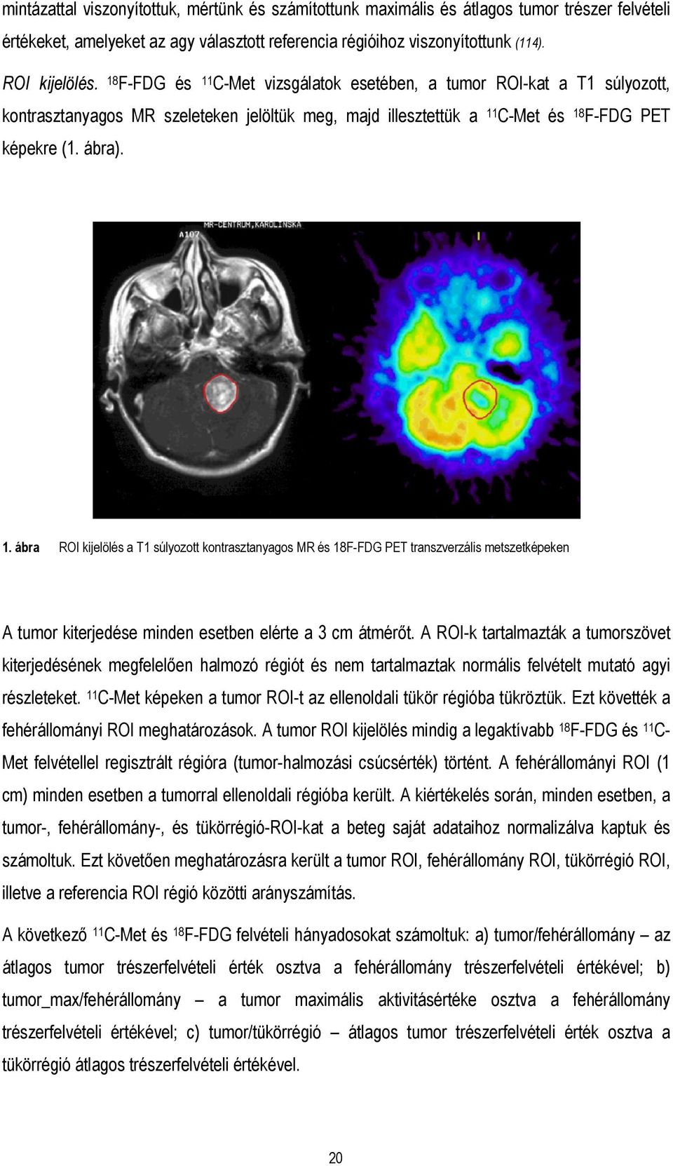 A ROI-k tartalmazták a tumorszövet kiterjedésének megfelelően halmozó régiót és nem tartalmaztak normális felvételt mutató agyi részleteket.