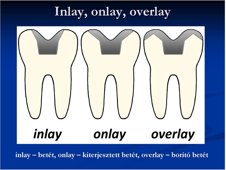 onlay kiterjesztett