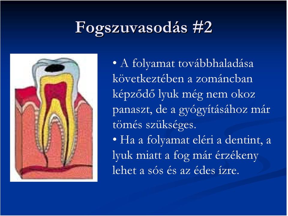 gyógyításához már tömés szükséges.