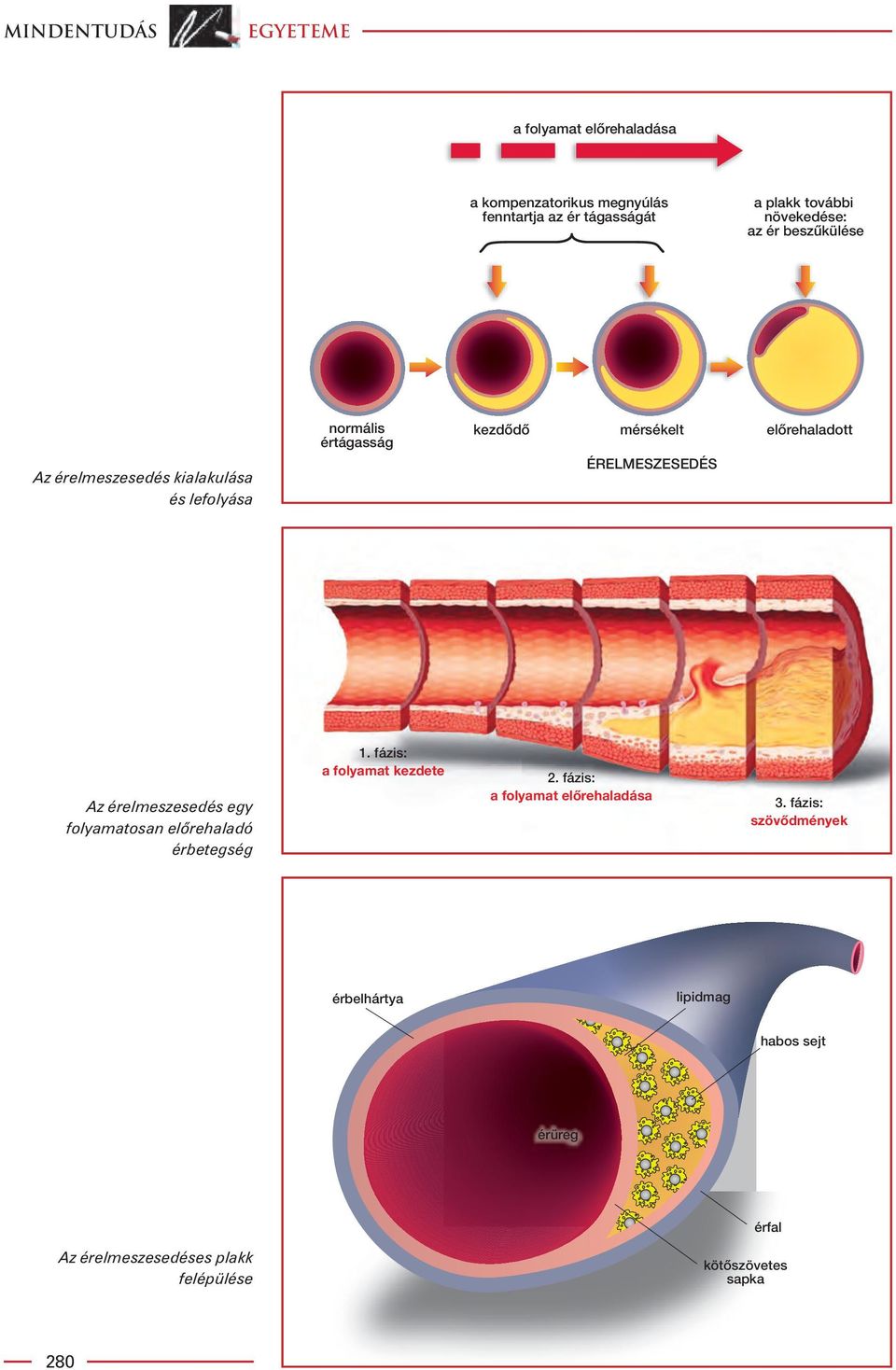 elôrehaladott Az érelmeszesedés egy folyamatosan elôrehaladó érbetegség 1. fázis: a folyamat kezdete 2.