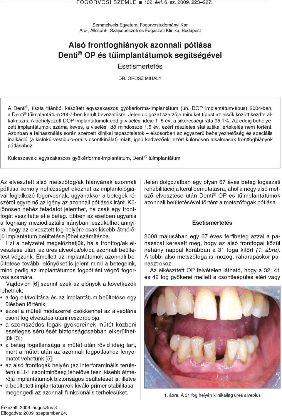 Dr. Orosz Mihály A Denti, tiszta titánból készített egyszakaszos gyökérforma-implantátum (ún. DOP implantátum-típus) 2004-ben, a Denti tűimplantátum 2007-ben került bevezetésre.