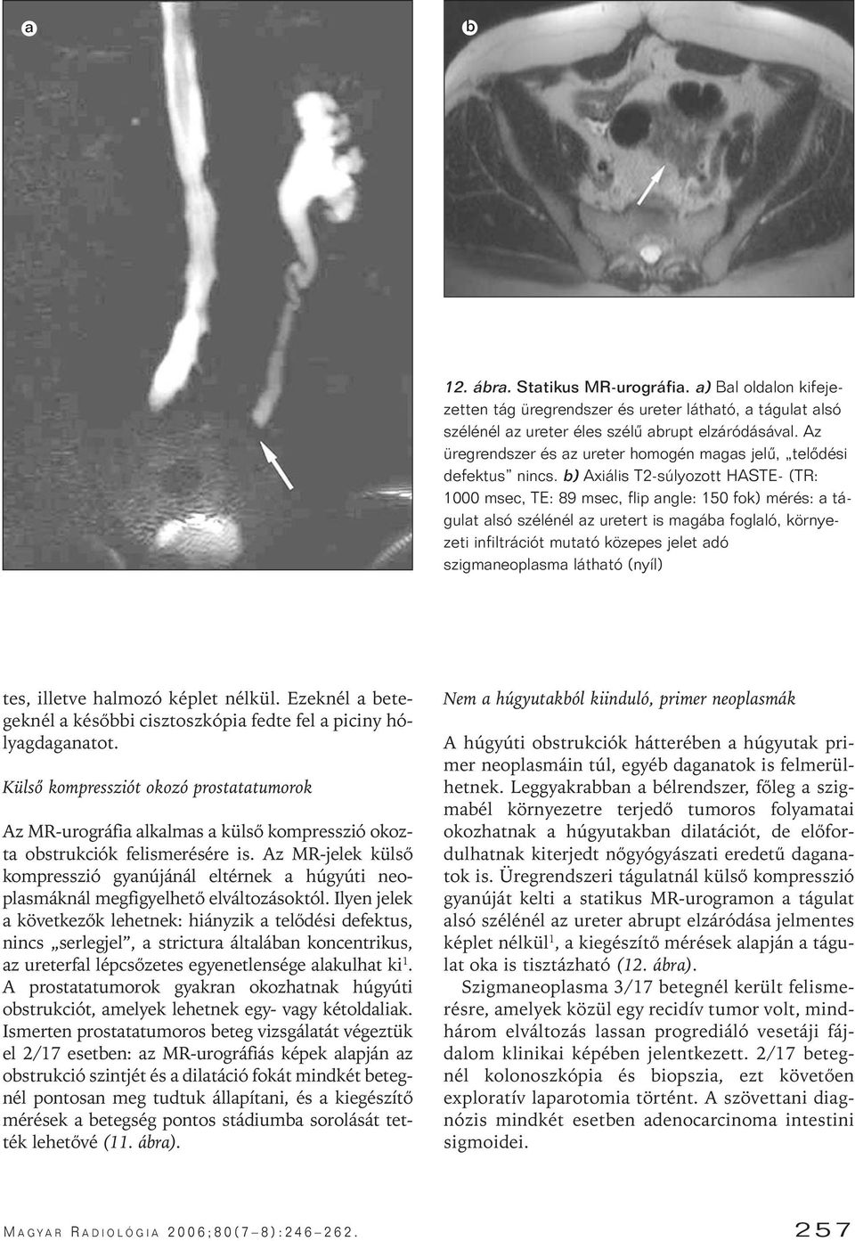 b) Axiális T2-súlyozott HASTE- (TR: 1000 msec, TE: 89 msec, flip angle: 150 fok) mérés: a tágulat alsó szélénél az uretert is magába foglaló, környezeti infiltrációt mutató közepes jelet adó