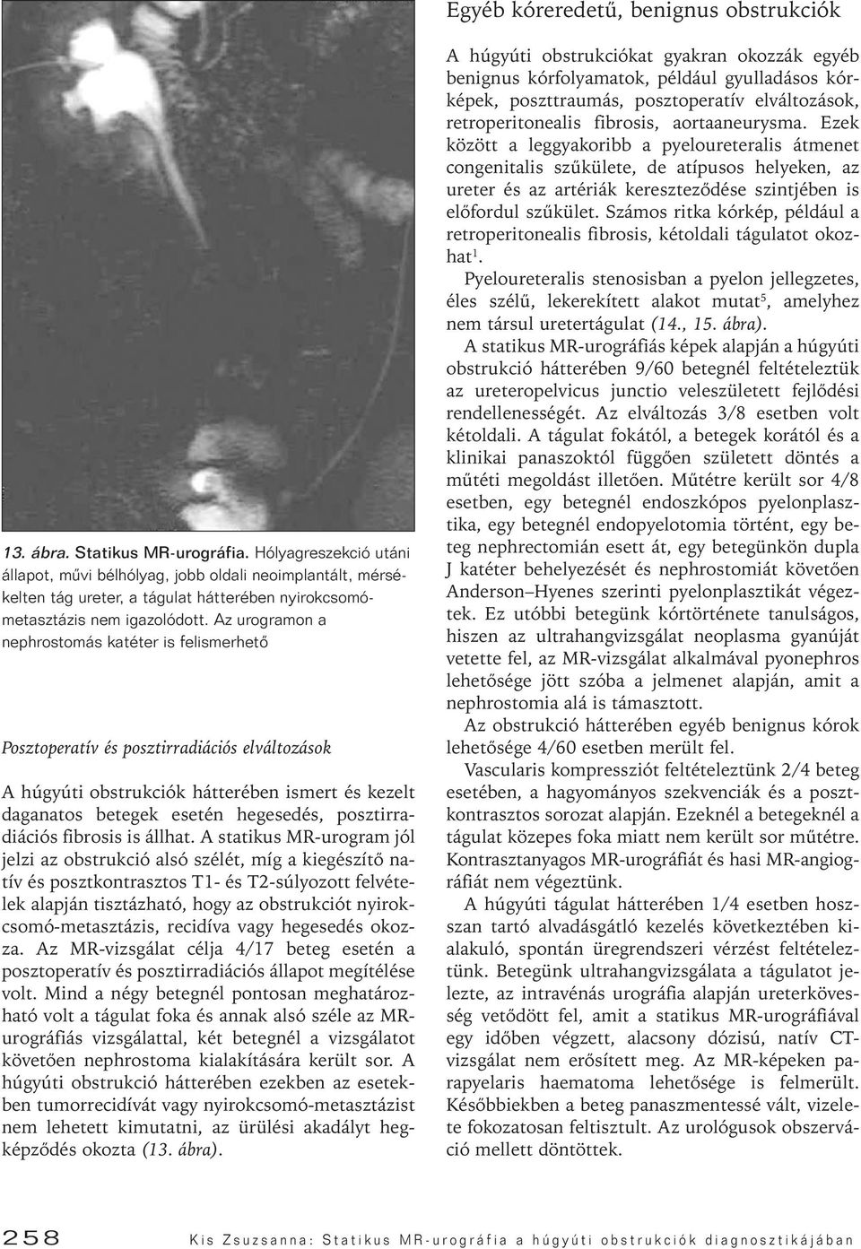 Az urogramon a nephrostomás katéter is felismerhetô Posztoperatív és posztirradiációs elváltozások A húgyúti obstrukciók hátterében ismert és kezelt daganatos betegek esetén hegesedés,