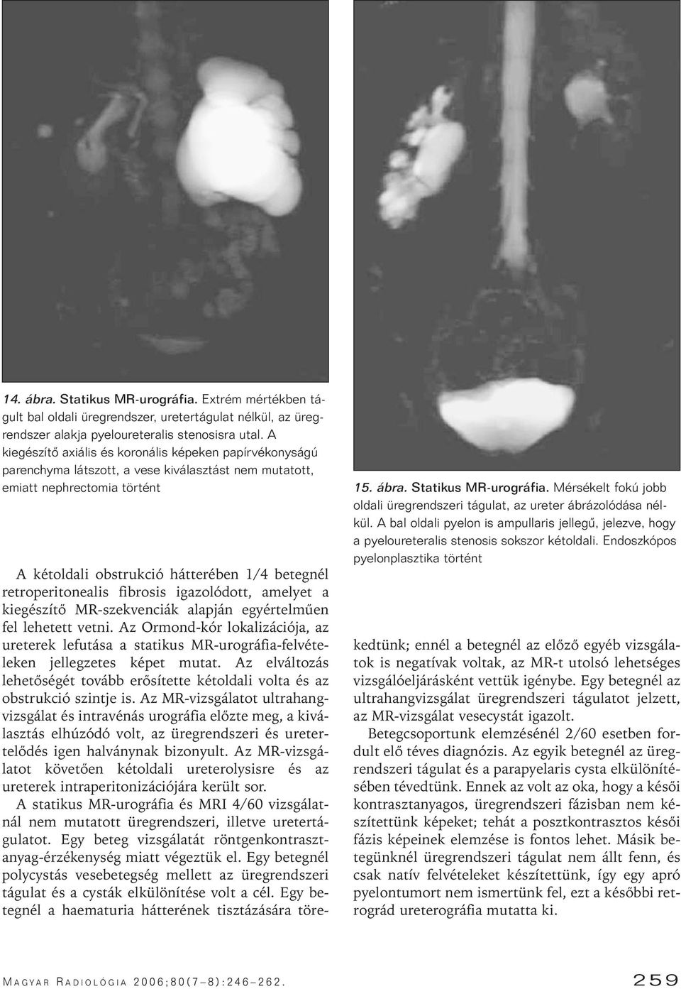 Mérsékelt fokú jobb oldali üregrendszeri tágulat, az ureter ábrázolódása nélkül. A bal oldali pyelon is ampullaris jellegû, jelezve, hogy a pyeloureteralis stenosis sokszor kétoldali.