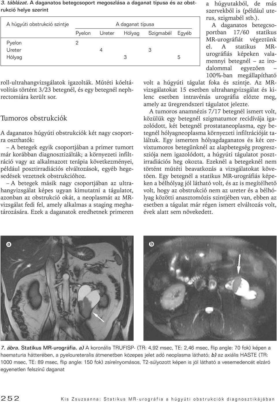 Tumoros obstrukciók A daganat típusa Pyelon Ureter Hólyag Szigmabél Egyéb Pyelon 2 Ureter 4 3 Hólyag 3 5 A daganatos húgyúti obstrukciók két nagy csoportra oszthatók: A betegek egyik csoportjában a