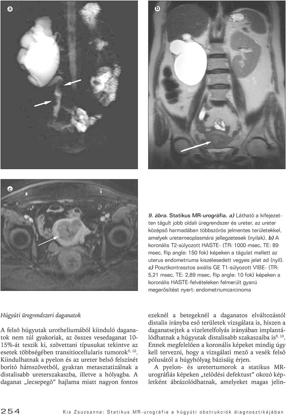 b) A koronális T2-súlyozott HASTE- (TR: 1000 msec, TE: 89 msec, flip angle: 150 fok) képeken a tágulat mellett az uterus endometriuma kiszélesedett vegyes jelet ad (nyíl).