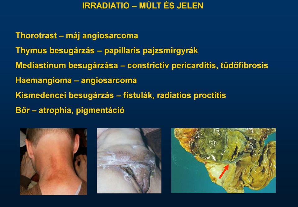 constrictiv pericarditis, tüdőfibrosis Haemangioma angiosarcoma