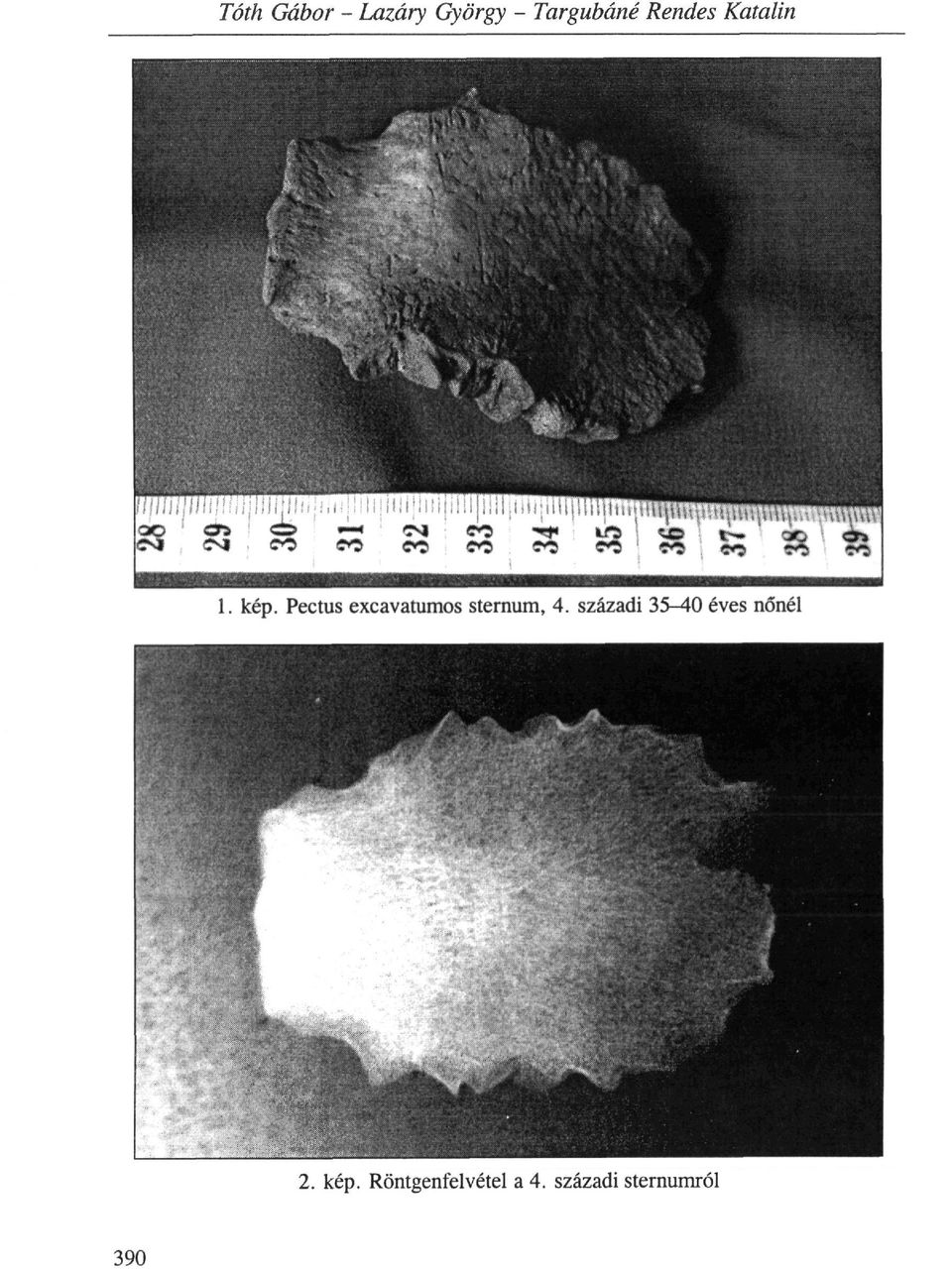 Pectus excavatumos sternum, 4.