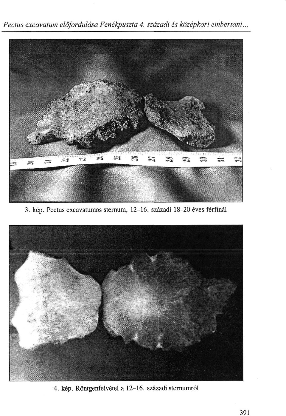 Pectus excavatumos sternum, 12-16.