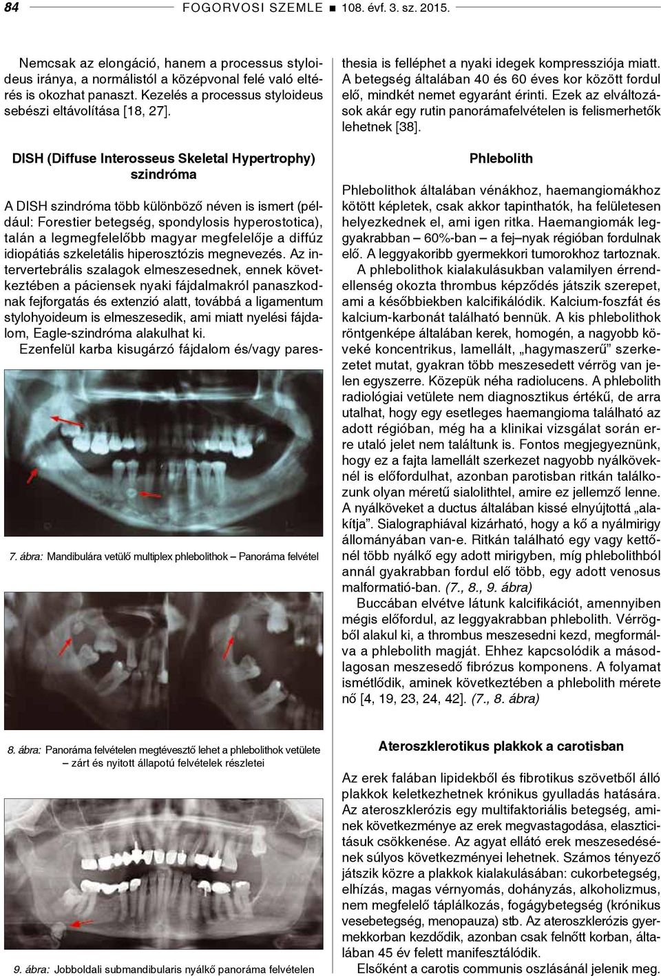ábra: Mandibulára vetülő multiplex phlebolithok Panoráma felvétel A DISH szindróma több különböző néven is ismert (például: Forestier betegség, spondylosis hyperostotica), talán a legmegfelelőbb