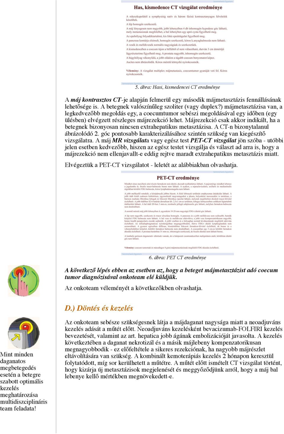Májrezekció csak akkor indikált, ha a betegnek bizonyosan nincsen extrahepatikus metasztázisa. A CT-n bizonytalanul ábrázolódó 2.
