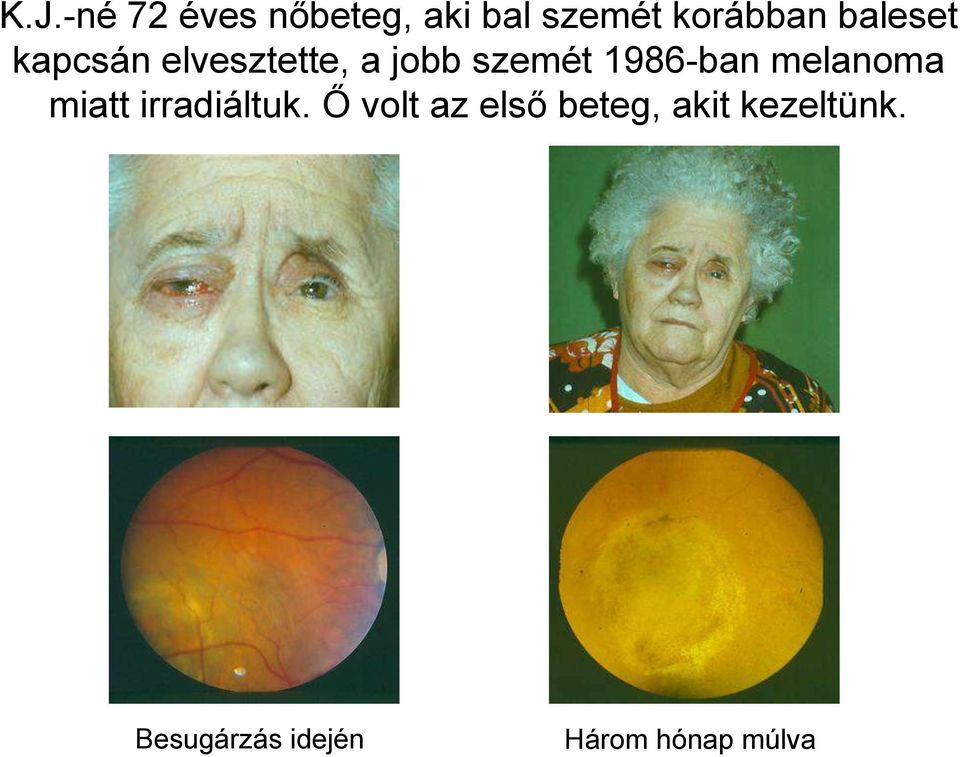 1986-ban melanoma miatt irradiáltuk.