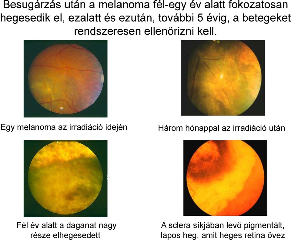 Egy melanoma az irradiáció idején Három hónappal az irradiáció után Fél év alatt a