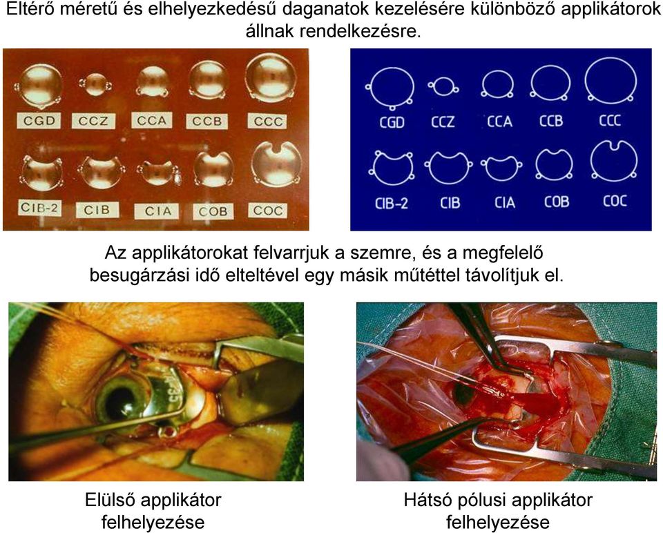 Az applikátorokat felvarrjuk a szemre, és a megfelelő besugárzási idő