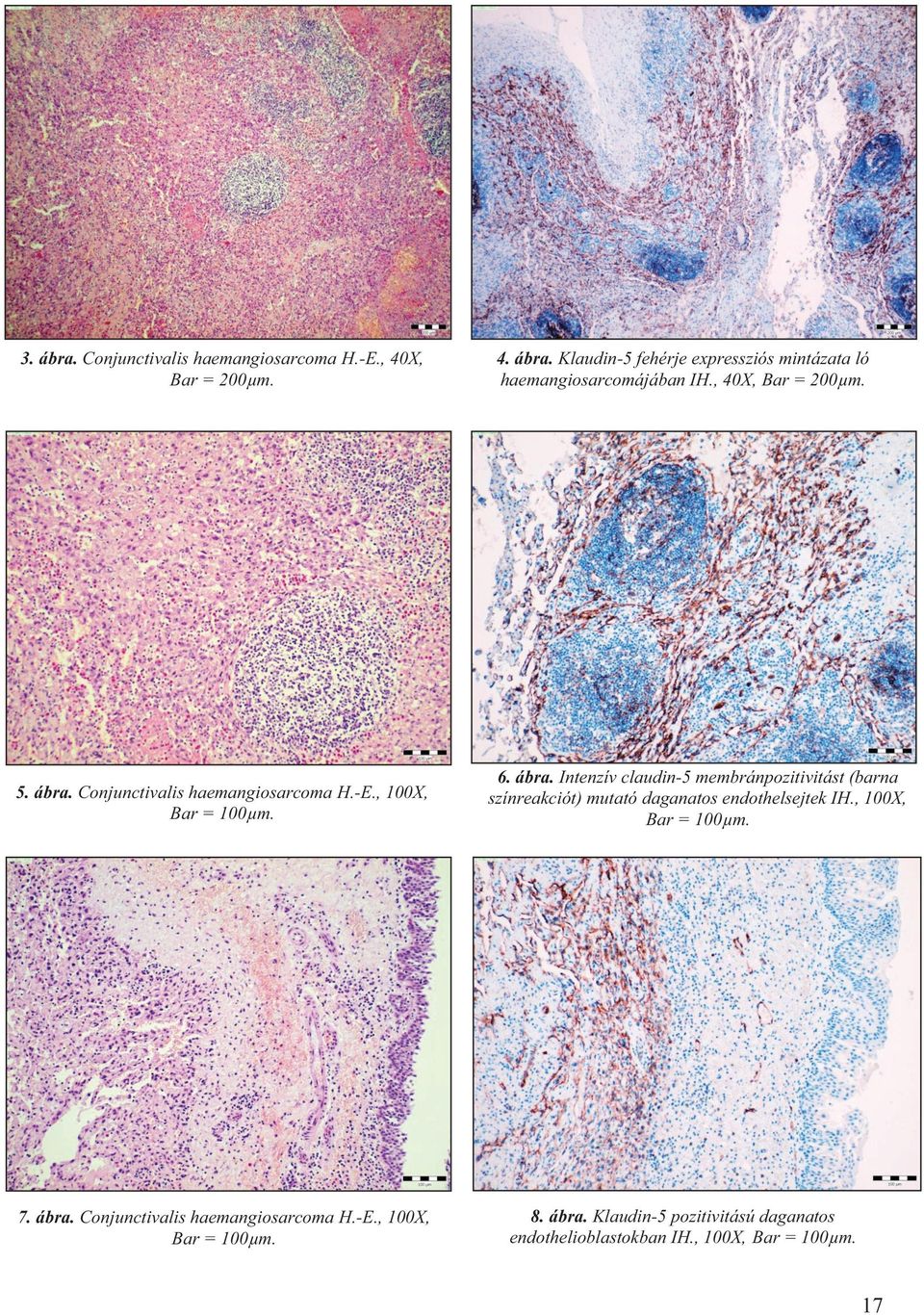 , 40X, Bar = 200µm. 6. ábra. Intenzív claudin-5 membránpozitivitást (barna színreakciót) mutató daganatos endothelsejtek IH.