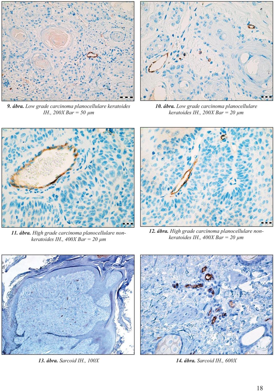 High grade carcinoma planocellulare nonkeratoides IH., 400X Bar = 20 µm 13. ábra. Sarcoid IH.