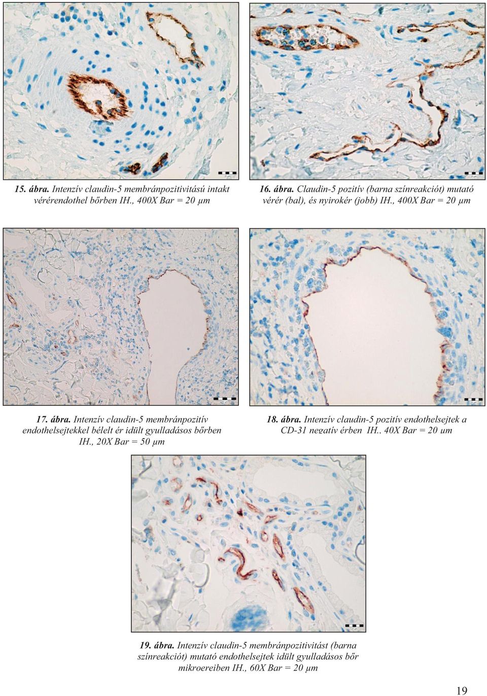 ábra. Intenzív claudin-5 pozitív endothelsejtek a CD-31 negatív érben IH., 40X Bar = 20 µm 19. ábra.