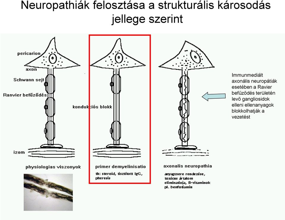 esetében a Ravier befűződés területén levő