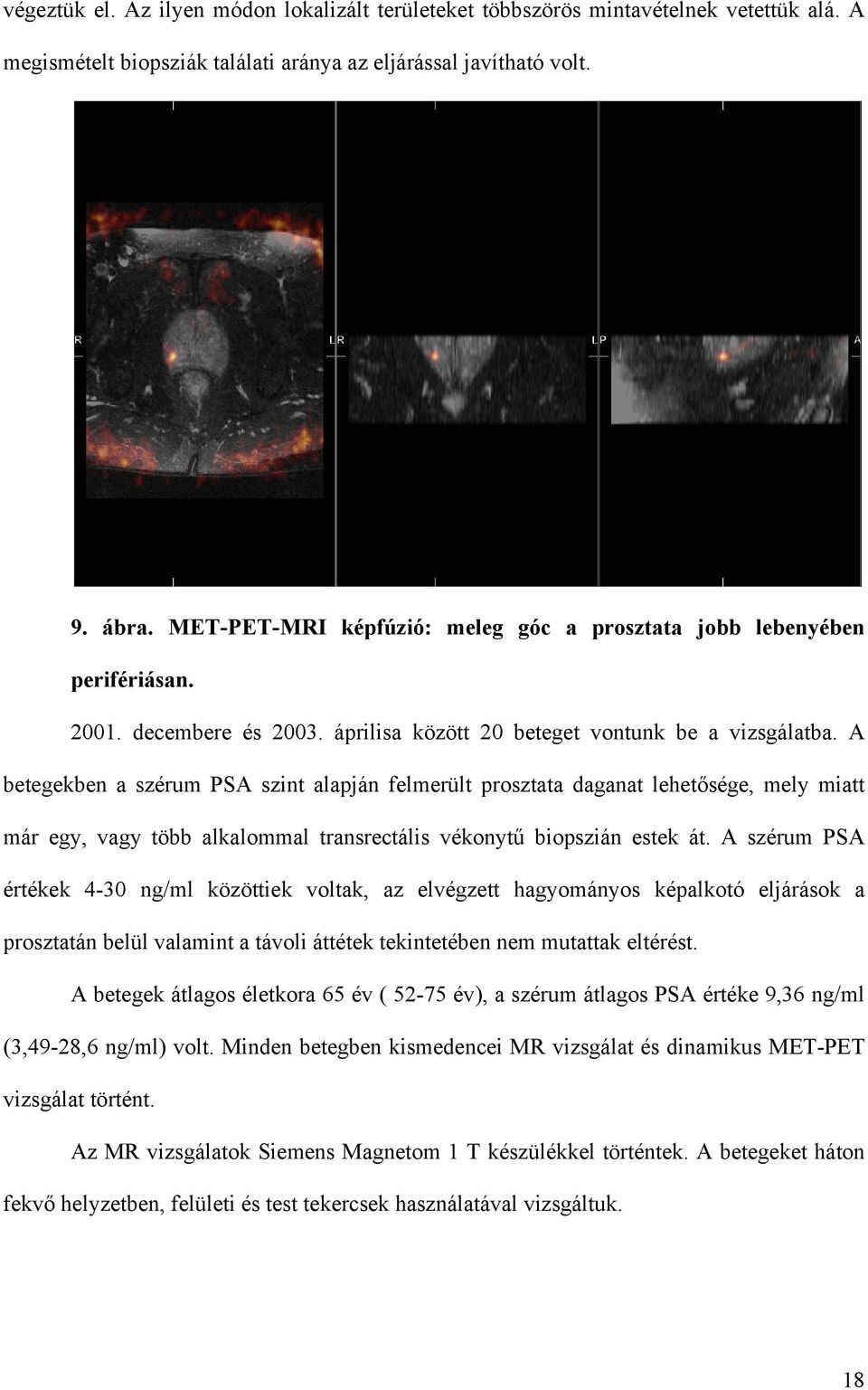 A betegekben a szérum PSA szint alapján felmerült prosztata daganat lehet sége, mely miatt már egy, vagy több alkalommal transrectális vékonyt biopszián estek át.