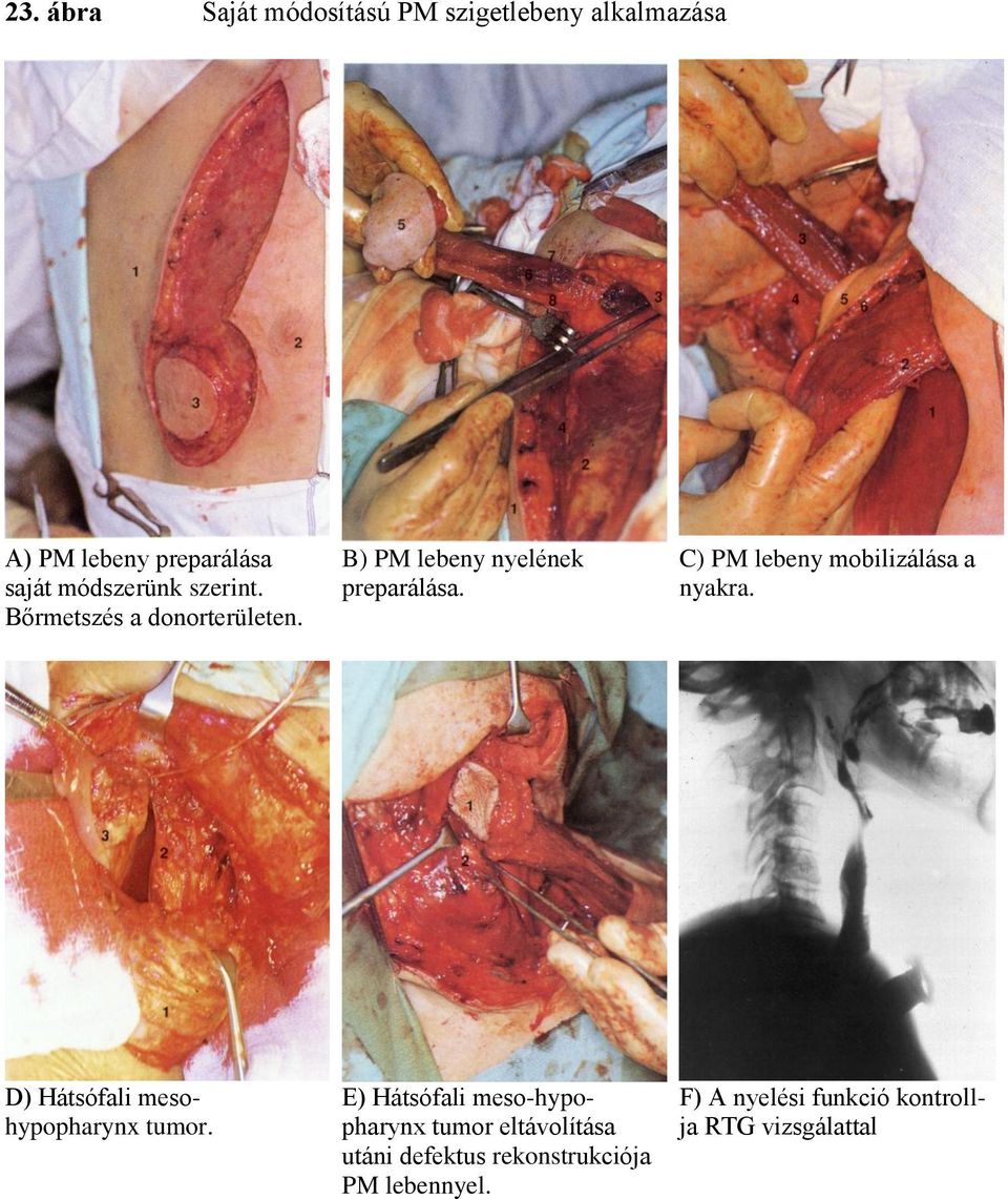 C) PM lebeny mobilizálása a nyakra. D) Hátsófali mesohypopharynx tumor.