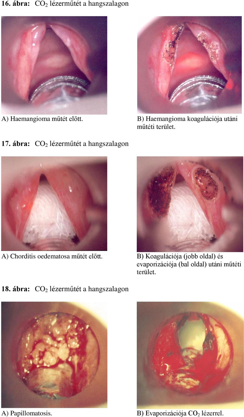 ábra: CO 2 lézerműtét a hangszalagon A) Chorditis oedematosa műtét előtt.