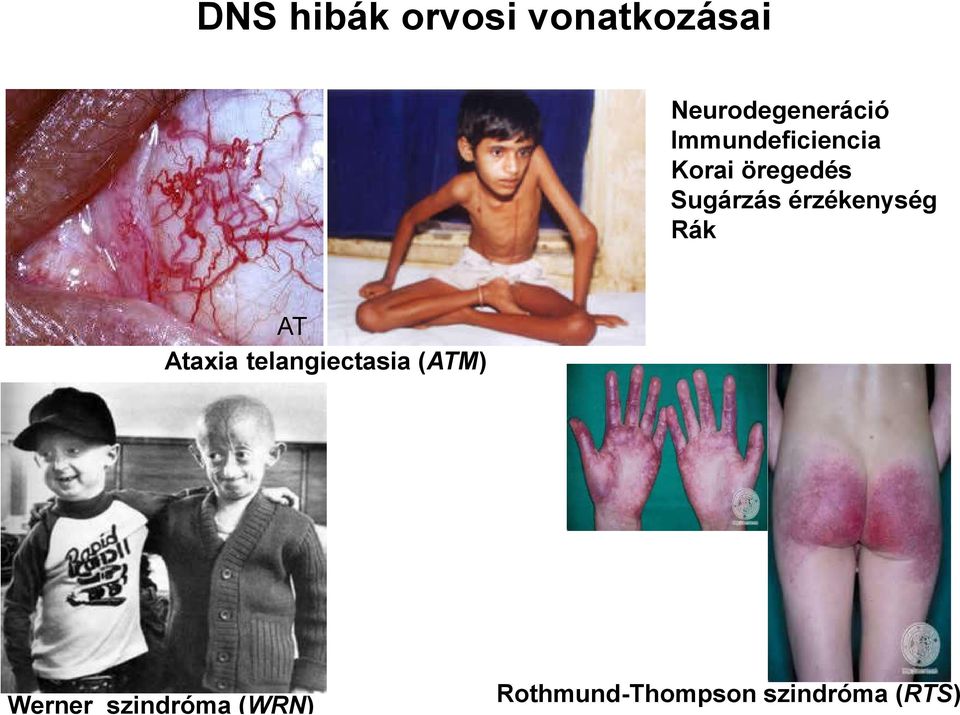 érzékenység Rák AT Ataxia telangiectasia (ATM)