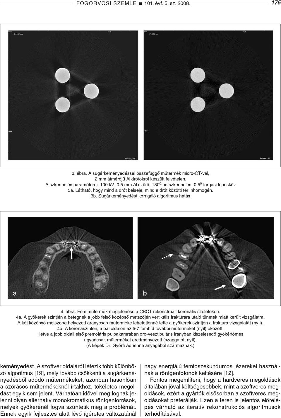 Sugárkeményedést korrigáló algoritmus hatás 4. ábra. Fém műtermék megjelenése a CBCT rekonstruált koronális szeleteken. 4a.