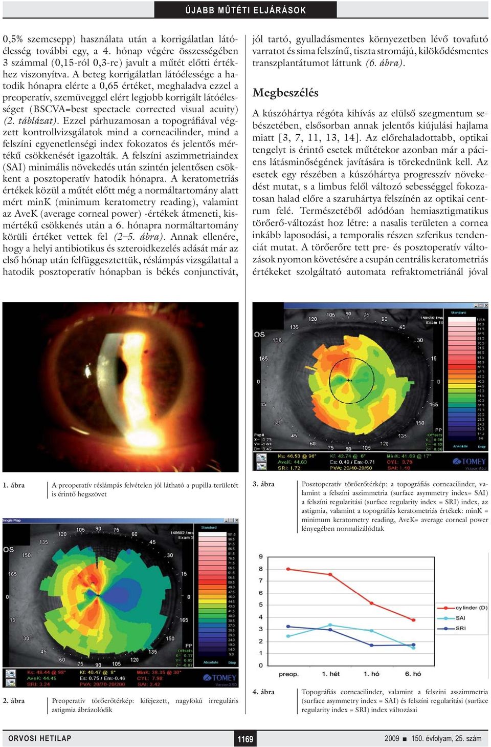 acuity) (2. táblázat). Ezzel párhuzamosan a topográfiával végzett kontrollvizsgálatok mind a corneacilinder, mind a felszíni egyenetlenségi index fokozatos és jelentős mértékű csökkenését igazolták.