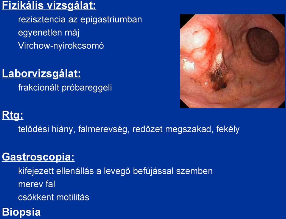 telődési hiány, falmerevség, redőzet megszakad, fekély Gastroscopia: