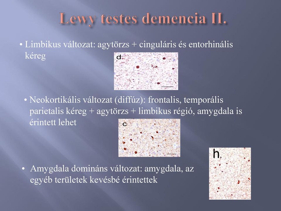 kéreg + agytörzs + limbikus régió, amygdala is érintett lehet