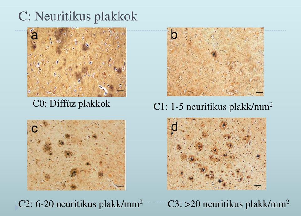 plakk/mm 2 C2: 6-20 neuritikus