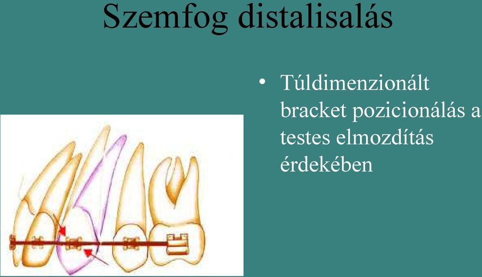 bracket pozicionálás