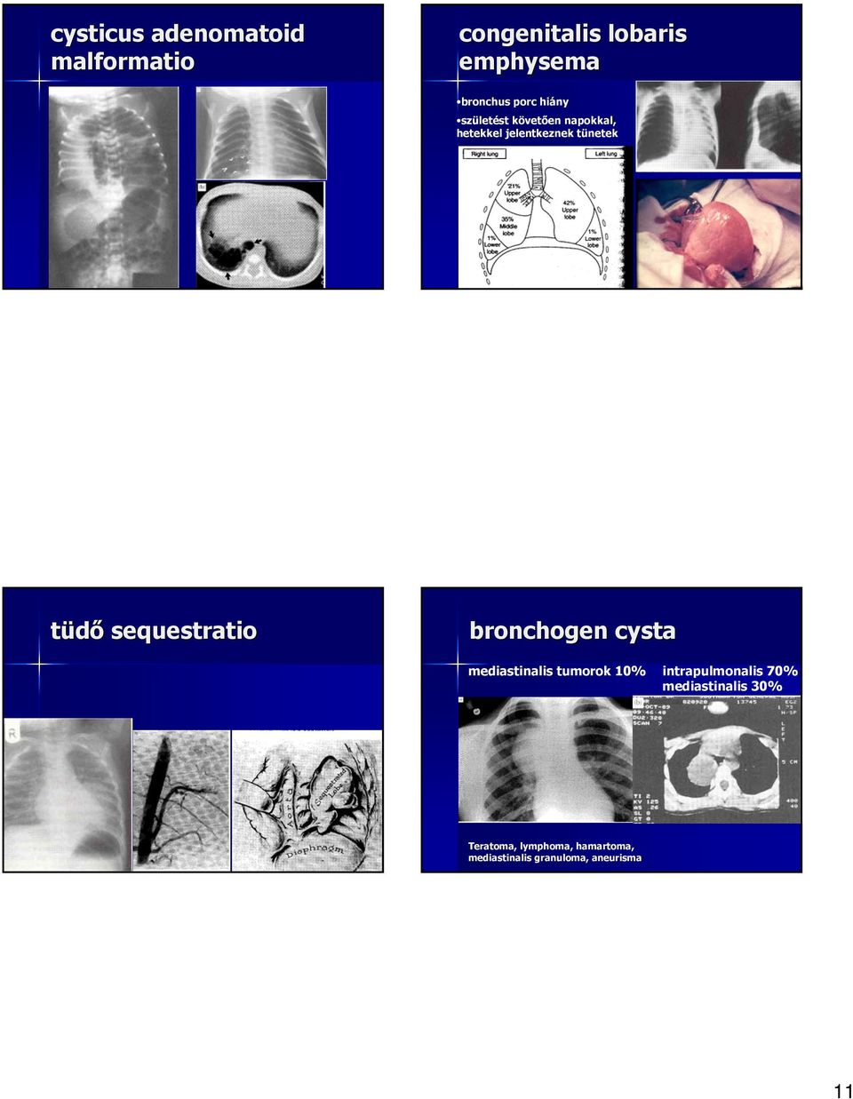 sequestratio bronchogen cysta mediastinalis tumorok 10% intrapulmonalis 70%