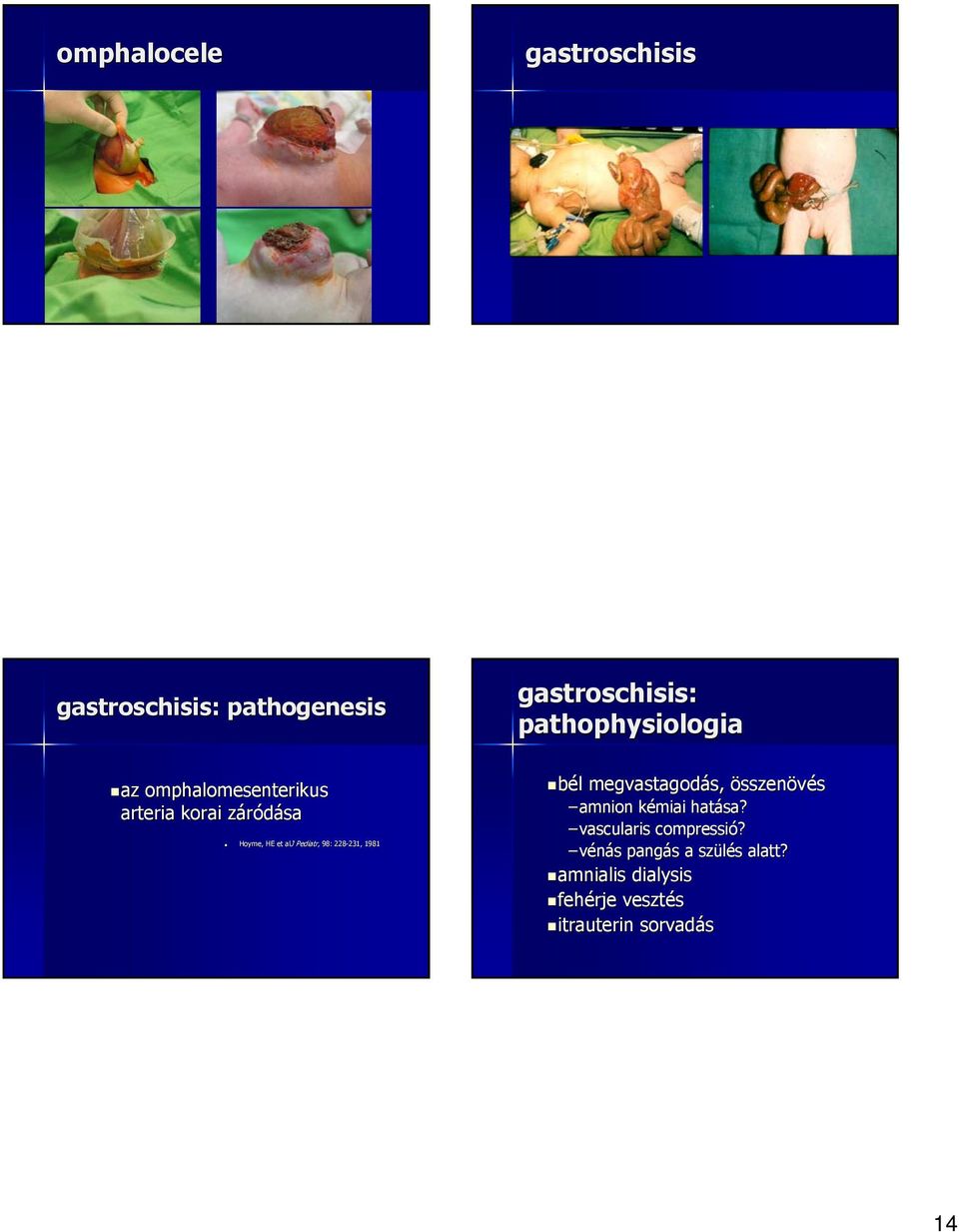 Hoyme, HE et alj J Pediatr,, 98: 228-231, 231, 1981 gastroschisis: pathophysiologia bél l