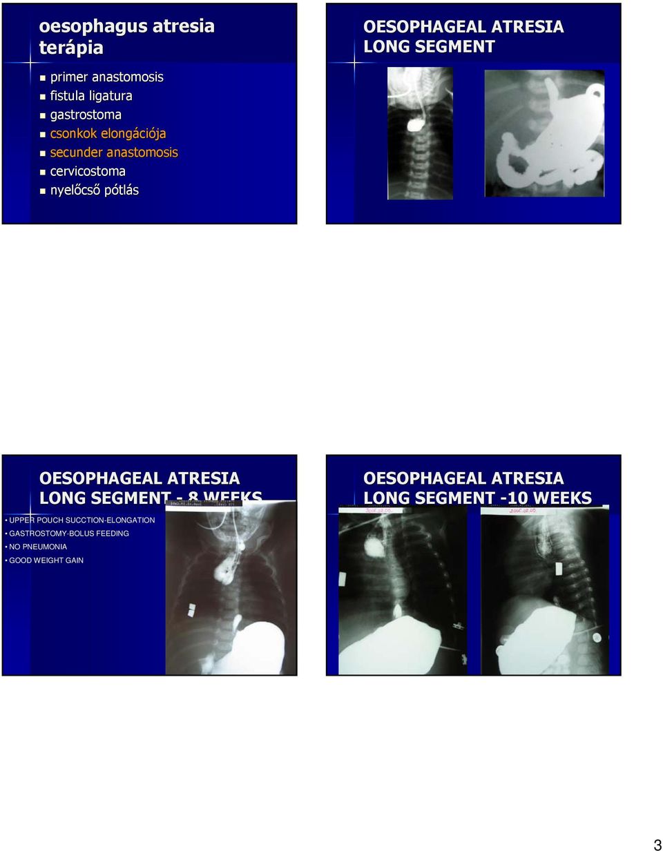 LONG SEGMENT OESOPHAGEAL ATRESIA LONG SEGMENT - 8 WEEKS UPPER POUCH SUCCTION-ELONGATION