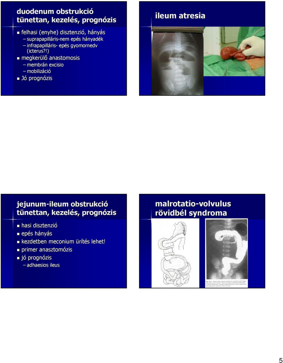 !) megkerülő anastomosis membrán excisio mobilizáci ció Jó prognózis jejunum-ileum obstrukció tünettan, kezelés,