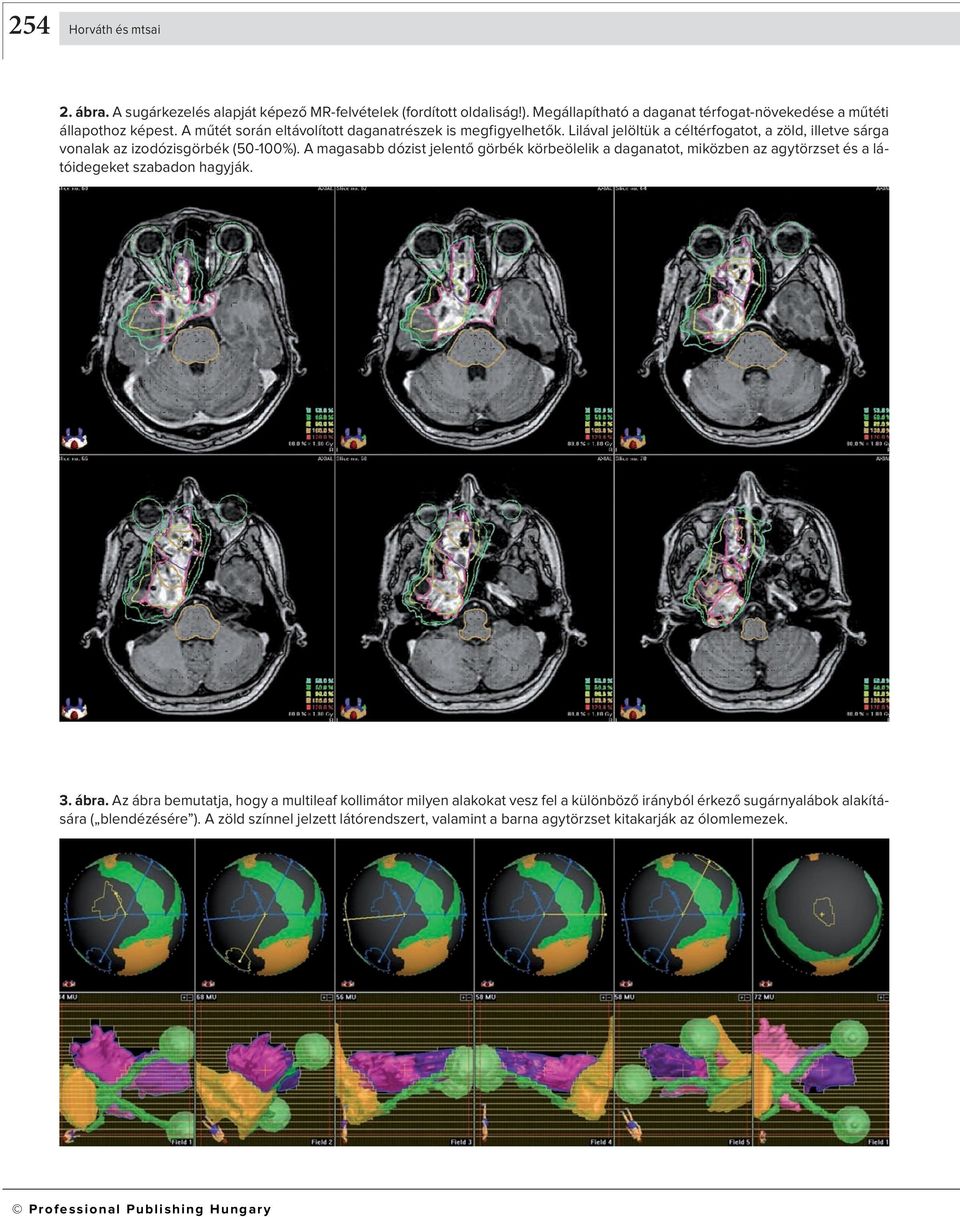 A magasabb dózist jelentő görbék körbeölelik a daganatot, miközben az agytörzset és a látóidegeket szabadon hagyják. 3. ábra.