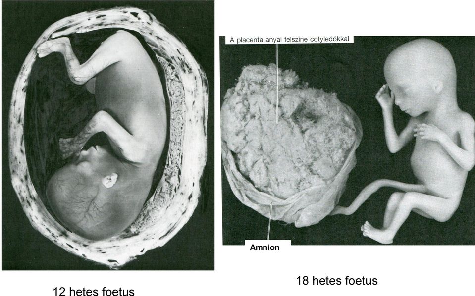 foetus 18