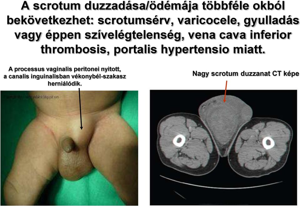 thrombosis, portalis hypertensio miatt.