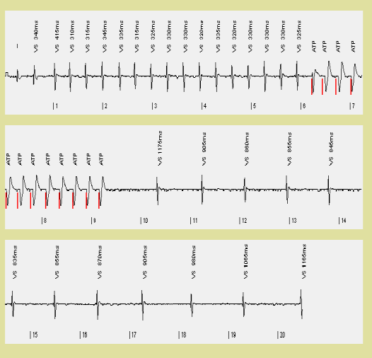 19 8. ábra: Bal oldal: gyors (200 msec)kt, amit az első 7 J sokk akcelerál, a KF-t a második, 20 J energiájú sokk szünteti meg.