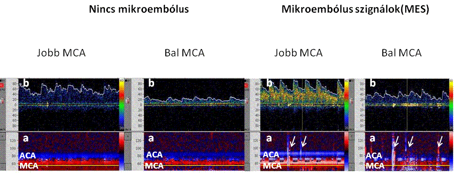 41 20. ábra: Transcraniális Doppler vizsgálattal mindkét oldalon az arteria cerebri mediában (MCA) regisztrált áramlási sebesség görbe látható, valamint az ereken (a.
